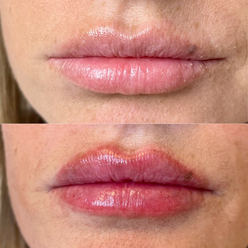 rosemedaesthetics lips a