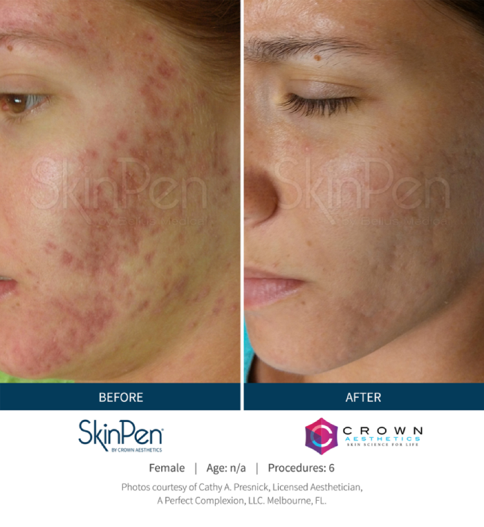 Rose Medical Aesthetics SkinPen BA acne 1