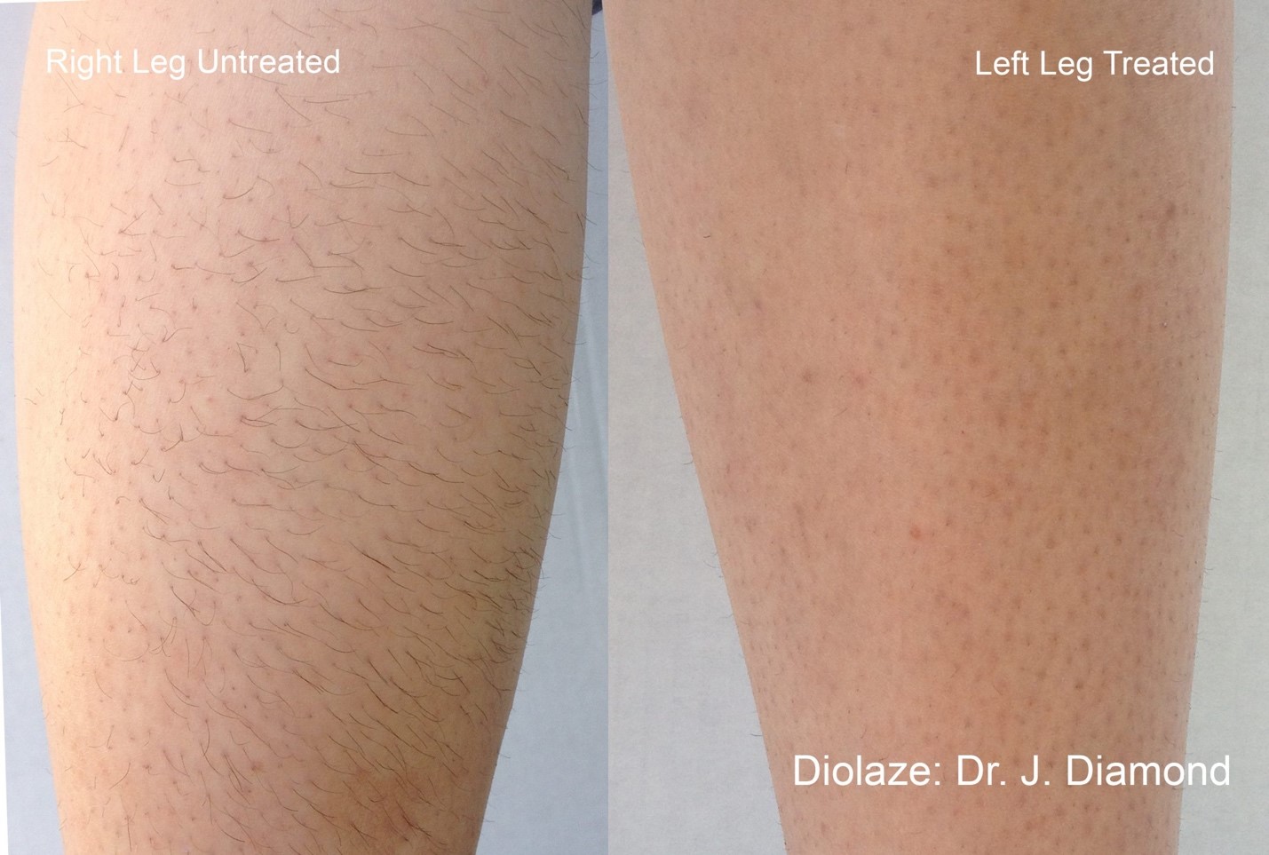 Laser hair removal BA