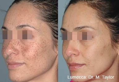 Lumecca IPL Photo facial before after