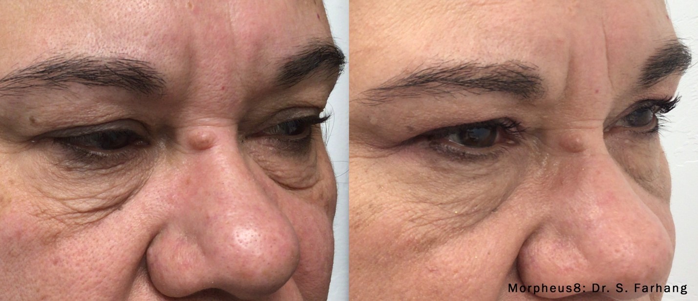 Morpheus8 Radiofrequency microneedling before after 1