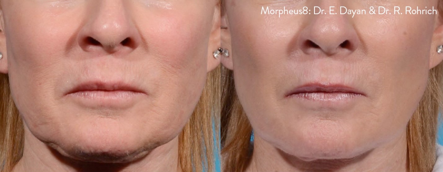 Morpheus8 Radiofrequency microneedling before after 2