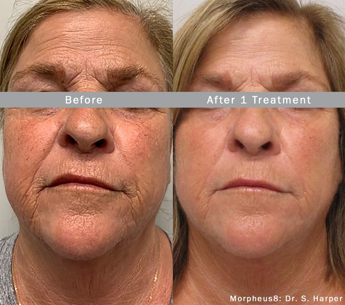 Morpheus8 Radiofrequency microneedling before after